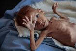 Guerra en Yemen ha dejado 85 mil niños muertos por hambruna, estima ONG