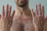 Un hombre muestra las ámpulas de su cuerpo