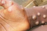 Una persona contagiada con viruela del mono