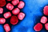 Micrografía electrónica de transmisión coloreada de partículas del virus de la viruela del mono
