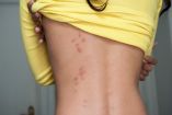 Las lesiones de chinches podrían trazar un camino en tu piel