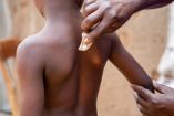 El Mpox se está dando principalmente en niños y adolescentes. (Reuters)
