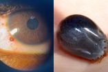 garrapata en el ojo