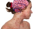 Depresión por inflamación del cerebro por dermatitis atópica. Foto: Canva.