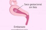 Qué es un embarazo anembrionario. Foto: Reproducción Asistida.
