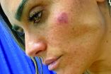 La alcaldesa Alessandra Rojo de la Vega fue golpeada en el rostro durante un operativo.