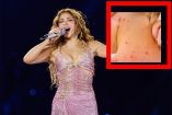 Concierto Shakira y sarampión