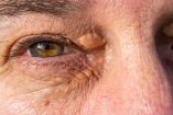 Colesterol en la mirada: 3 señales en tus ojos que revelan arterias obstruidas hoy