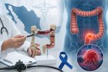 Ilustración sobre el cáncer colorrectal en México.