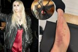 Taylor Momsen hospitalizada: qué hacer ante una picadura de araña venenosa