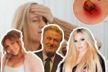 Famosos que padecen la enfermedad de Lyme