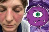 ¿Por qué el lupus afecta más a las mujeres y cómo detectarlo?