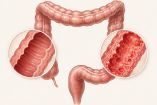 La enfermedad de Chrohn afecta el intestino grueso