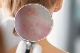 ¿Por qué salen manchas rojas en la piel? Causas, síntomas y cuándo acudir al médico