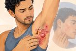 Acne invertido