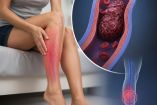 Trombosis en la mujer: ¿Por qué su riesgo de sufrir un trombo se quintuplica?