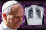 Al Papa le fue diagnosticado un adenocarcinoma