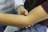 La hemofilia afecta la capacidad de la sangre para coagular adecuadamente
