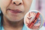 Trombólisis intravenosa y trombectomía: tratamientos para un ACV isquémico