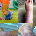 Así va el tobillo de Alexis Sánchez tras dura entrada (Fotos tomada de @Alexis_Sanchez)