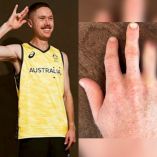 Matthew Dawson se amputa dedo con tal de jugar en París 2024 con Australia.