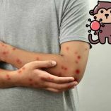 La viruela del mono llama la atención de la OMS por su potencial para ser la próxima pandemia. Canva.