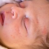 ¿Es normal que mi bebé tenga barritos?