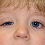 Día de concienciación del Síndrome de PACS1 o Schuurs-Hoeijmakers; qué es y por qué se conmemora.