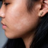 ¿Por qué aparecen los jiotes en la cara?