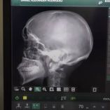 Como consecuencia de la golpiza, el estudiante del CBTIS 24 presenta múltiples lesiones y traumatismos en la región craneal que requirieron atención hospitalaria de urgencia.