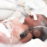 Día Mundial del Síndrome de Edwards o Trisomía 18; qué es y por qué se conmemora.