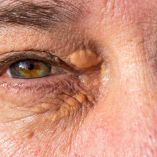 Colesterol en la mirada: 3 señales en tus ojos que revelan arterias obstruidas hoy