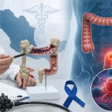 Ilustración sobre el cáncer colorrectal en México.