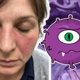 ¿Por qué el lupus afecta más a las mujeres y cómo detectarlo?