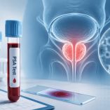 El cáncer de próstata puede ser detectado con una muestra de sangre