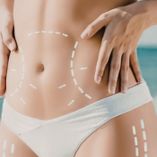 Remodelación de cintura sin incisiones: La innovación ecoguiada que transforma la cirugía estética