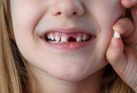 ¿Por qué se caen los dientes de leche antes de tiempo?