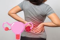 ¿El dolor lumbar es señal de cáncer de ovario?