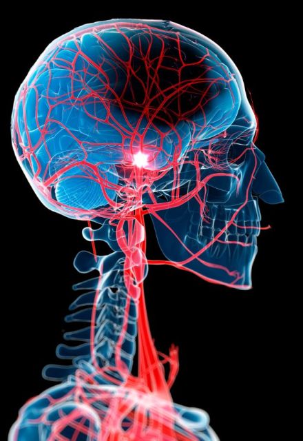 Trombólisis intravenosa y trombectomía: tratamientos para un ACV isquémico