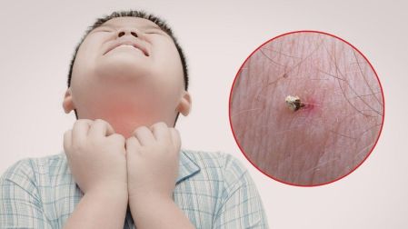¿Qué hacer si te pica una abeja?