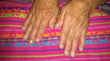 thumb