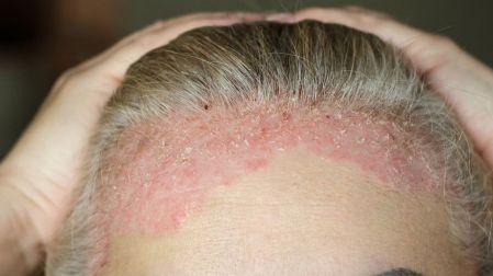 ¿Por qué salen manchas rojas en la piel? Causas, síntomas y cuándo acudir al médico