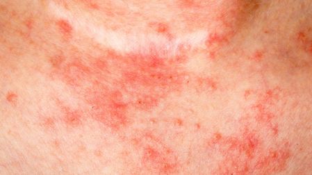 ¿Por qué salen manchas rojas en la piel? Causas, síntomas y cuándo acudir al médico