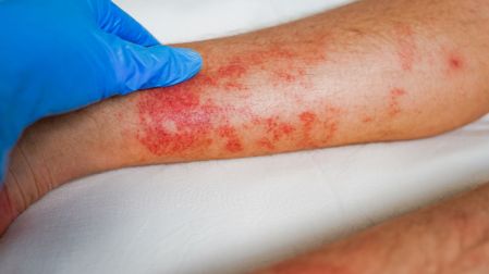¿Por qué salen manchas rojas en la piel? Causas, síntomas y cuándo acudir al médico