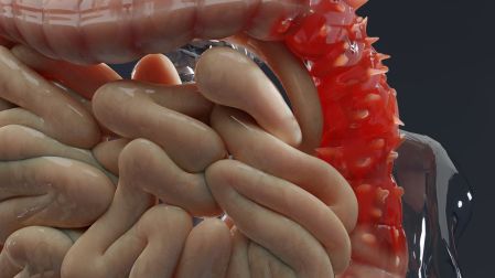 ¿La colitis nerviosa puede convertirse en colitis ulcerosa? Respuestas médicas