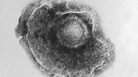 El virus de la varicela