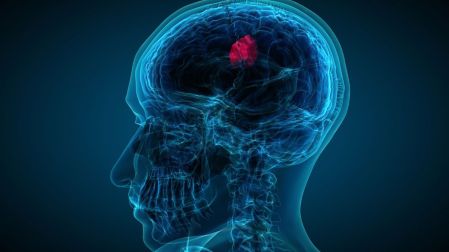 ¿Cuándo el dolor de cabeza puede ser síntoma de tumor cerebral?