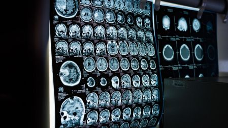 ¿Cuándo el dolor de cabeza puede ser síntoma de tumor cerebral?