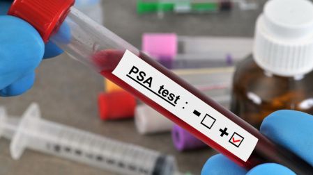¿A qué edad se debe hacer la prueba del cáncer de próstata?
