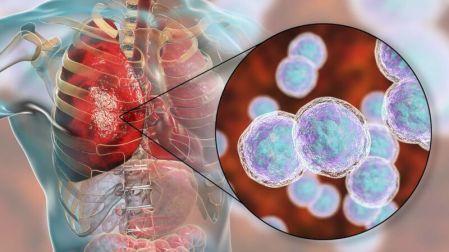La neumonía afecta gravemente los pulmones.
